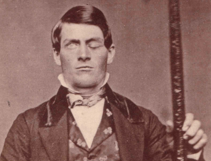 The Curious Case of Phineas P. Gage